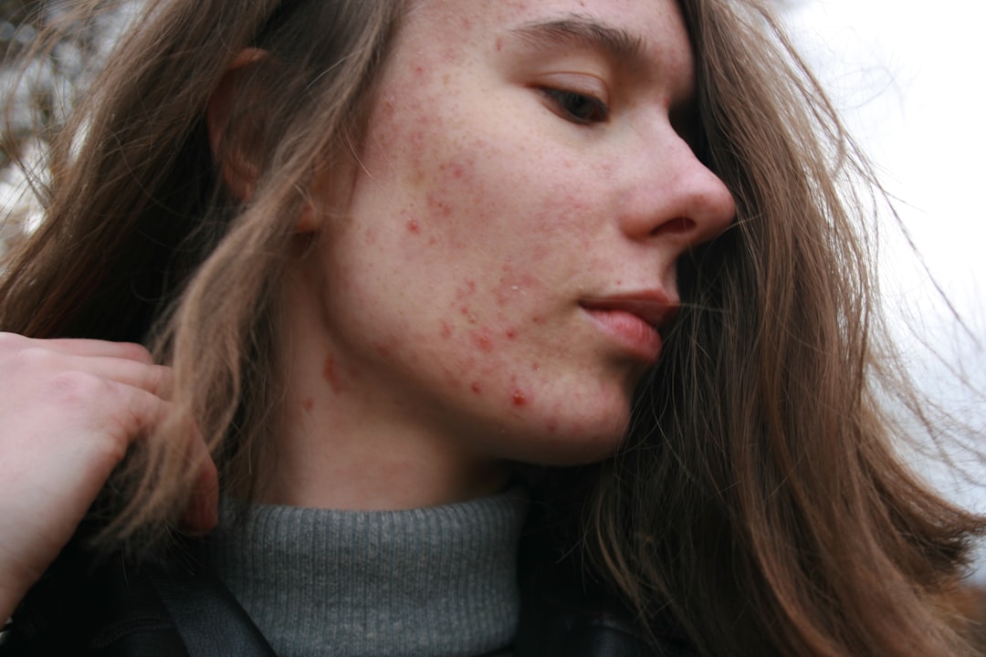 The Best Facials for Acne-Prone Skin — Luxury Lashes Federal Way WA