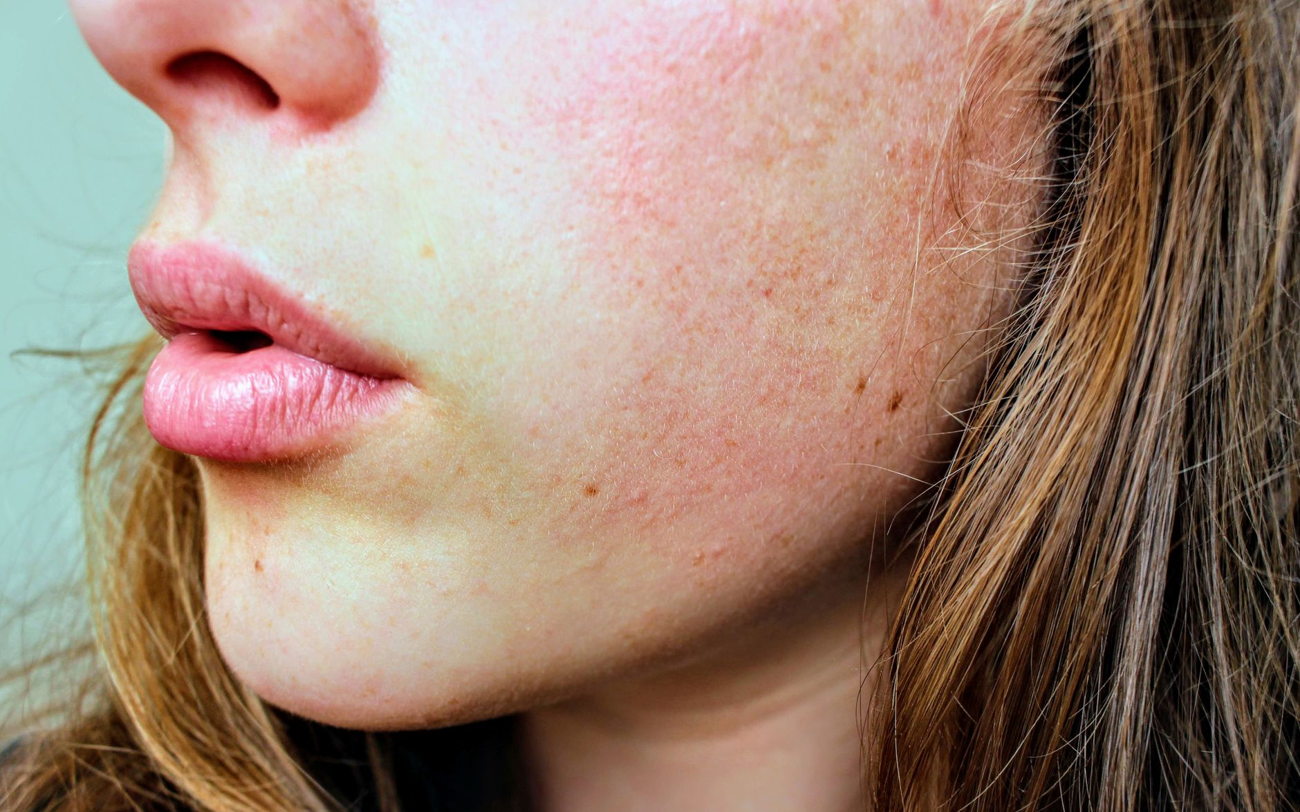 blackhead skincare treatment closeup — Luxury Lashes Federal Way WA