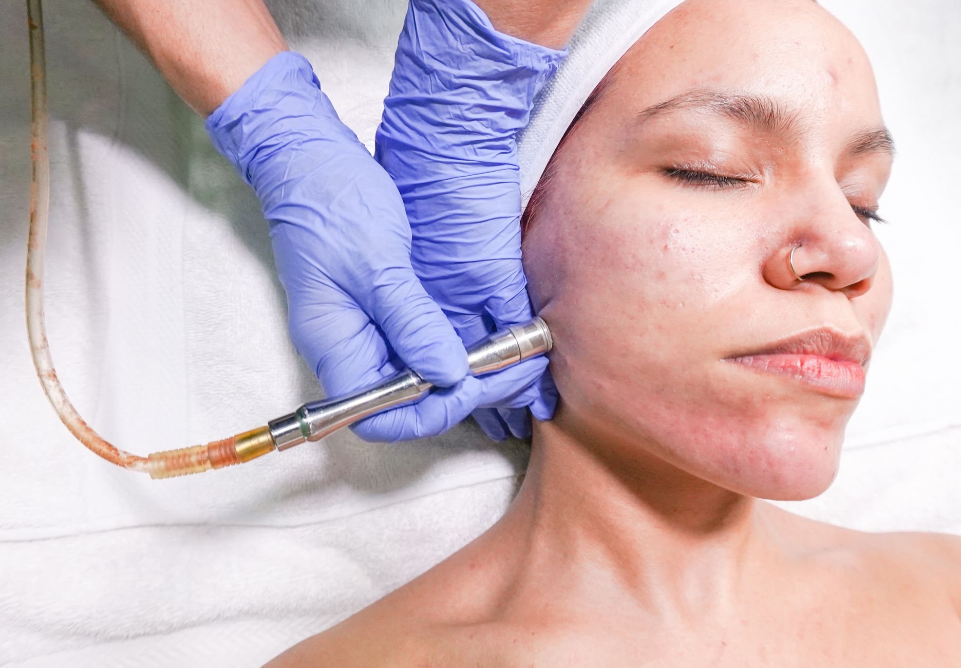What Is Microdermabrasion? Benefits & What to Expect
